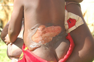 Burned Child In Malawi receives treatment