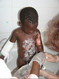 Martha being treated for burns on her arms and torso